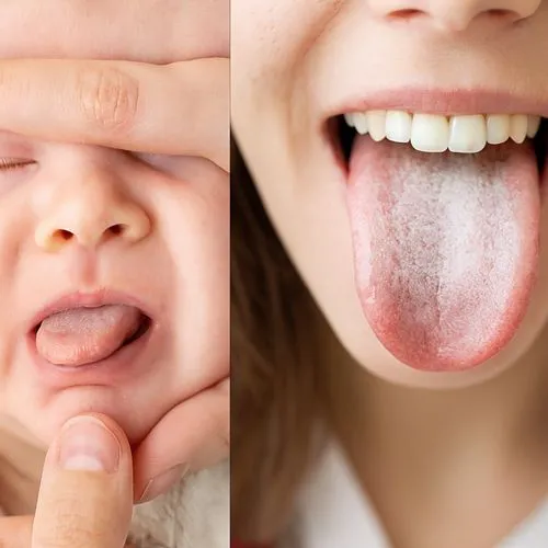 Foto Candidíase oral sapinho