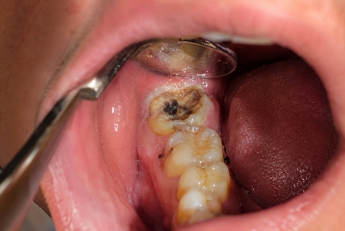 Foto de Dente Siso Podre