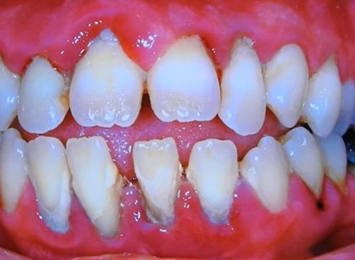 Fotos de dentes afetados por Biofilme bacteriano