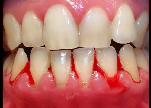 Fotos de dentes afetados por Fusobacterium nucleatum