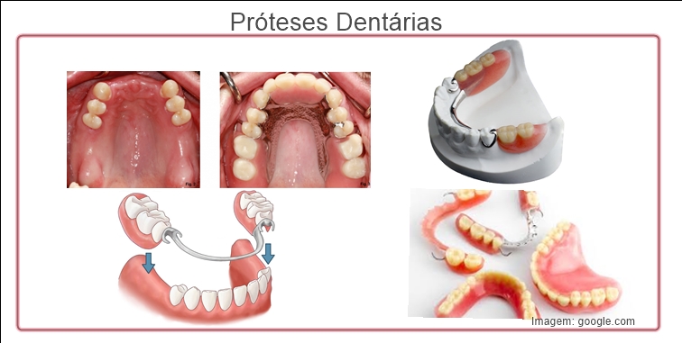 tipos de protese dentaria