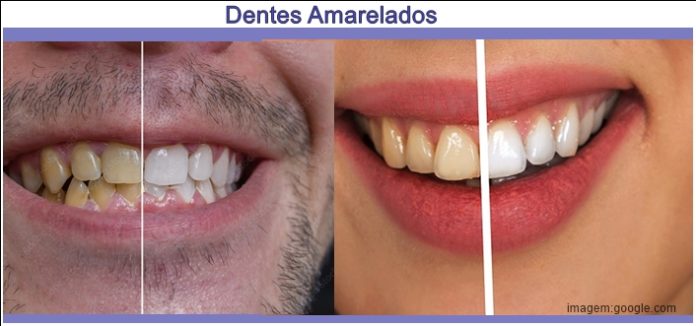 O que causa os Dentes Amarelados