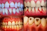 Bactérias da Boca que Causam Doenças