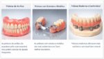 Modelos de prótese dentária